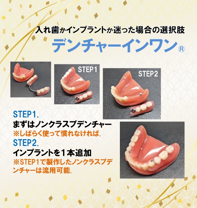 デンチャーインワン®は迷った時の第三の選択肢